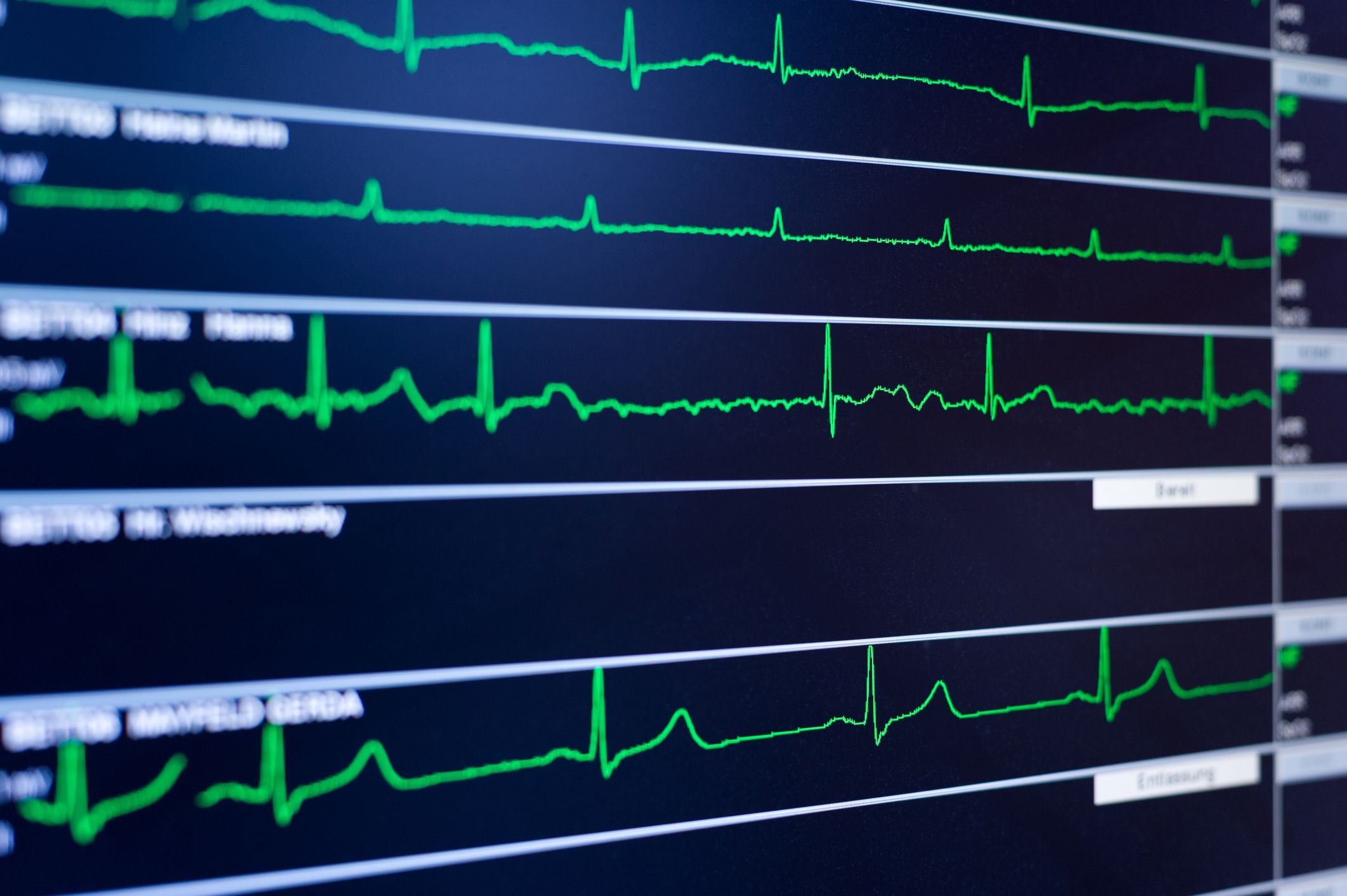 اختلال ریتم قلب 🔗