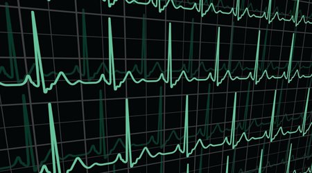 هولتر ریتم قلب 🔗