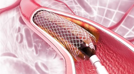 آنژیوپلاستی عروق  کرونر 🔗