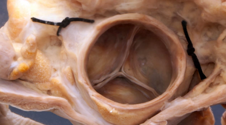 دریچه آئورت 🔗