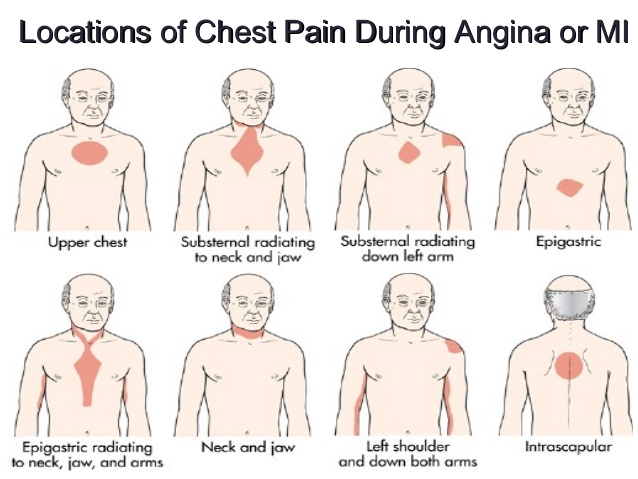 مناطقی از قفسه سینه که درد سکته قلبی میتواند در آنها ایجاد شود.