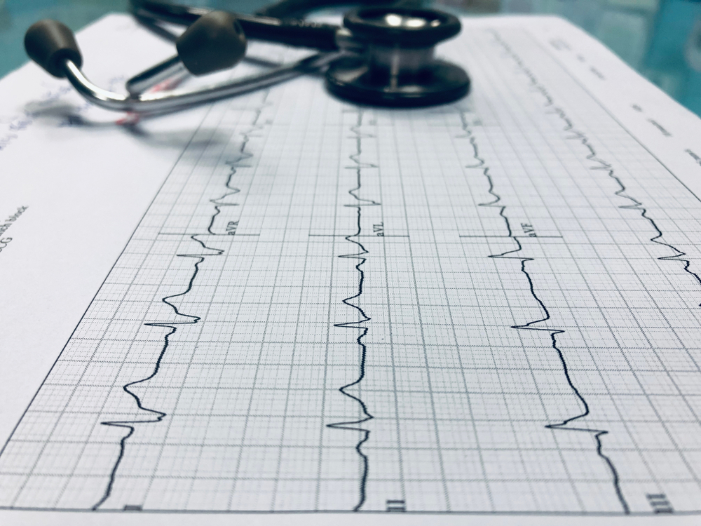 چگونه آریتمی ها تشخیص داده می شوند؟