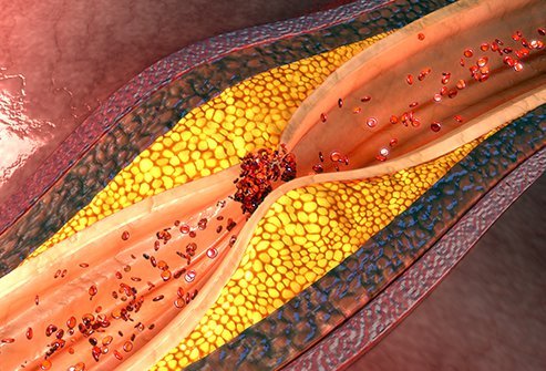 ایسکمی قلب چیست؟
