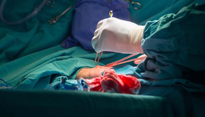 مراحل انجام عمل جراحی بای پس عروق کرونر قلب