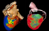 اسکن هسته ای قلب  Myocardial Perfusion Imaging
