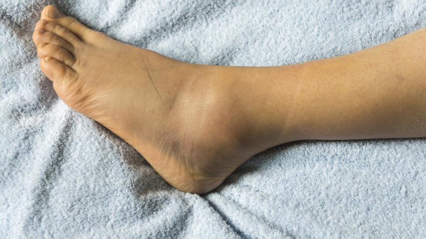 ادم و تورم مچ پا در اثر مصرف قرص "آملودیپین"