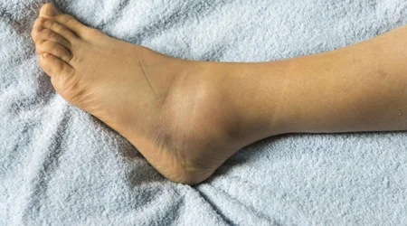 ادم و تورم مچ پا در اثر مصرف قرص "آملودیپین"