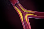 تنگی عروق کرونر قلب Coronary Artery Diseases