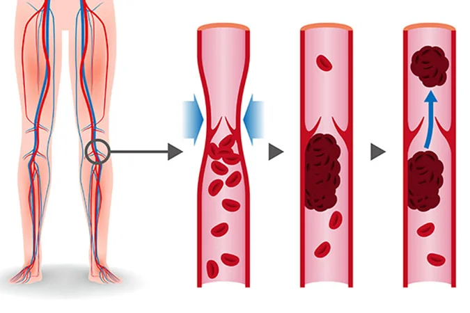 علل ایجاد لخته خون در بدن (ترومبوز)