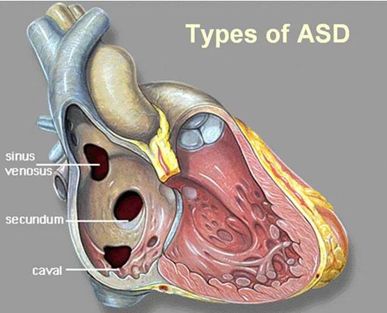 انواع ASD