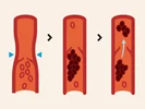 تشکیل لخته خون در وریدهای عمقی پا DVT
